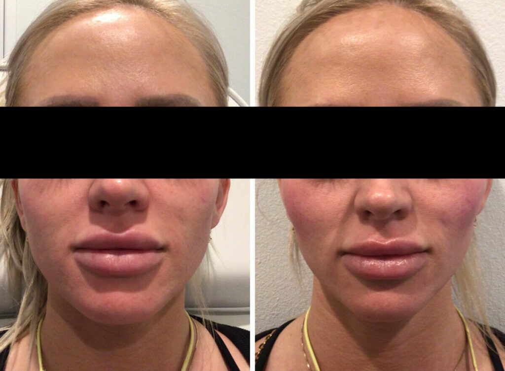 Cheek filler before and after