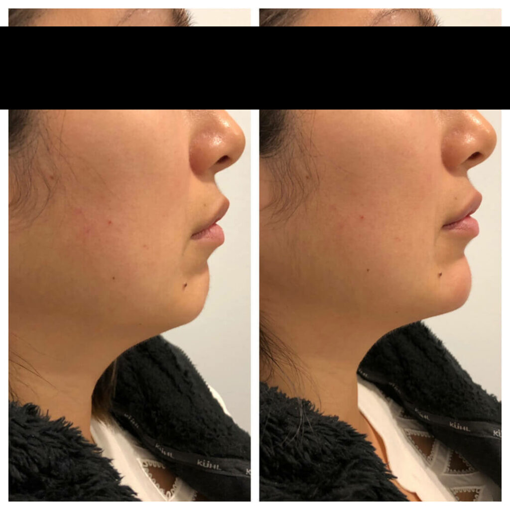 Chin filler before after