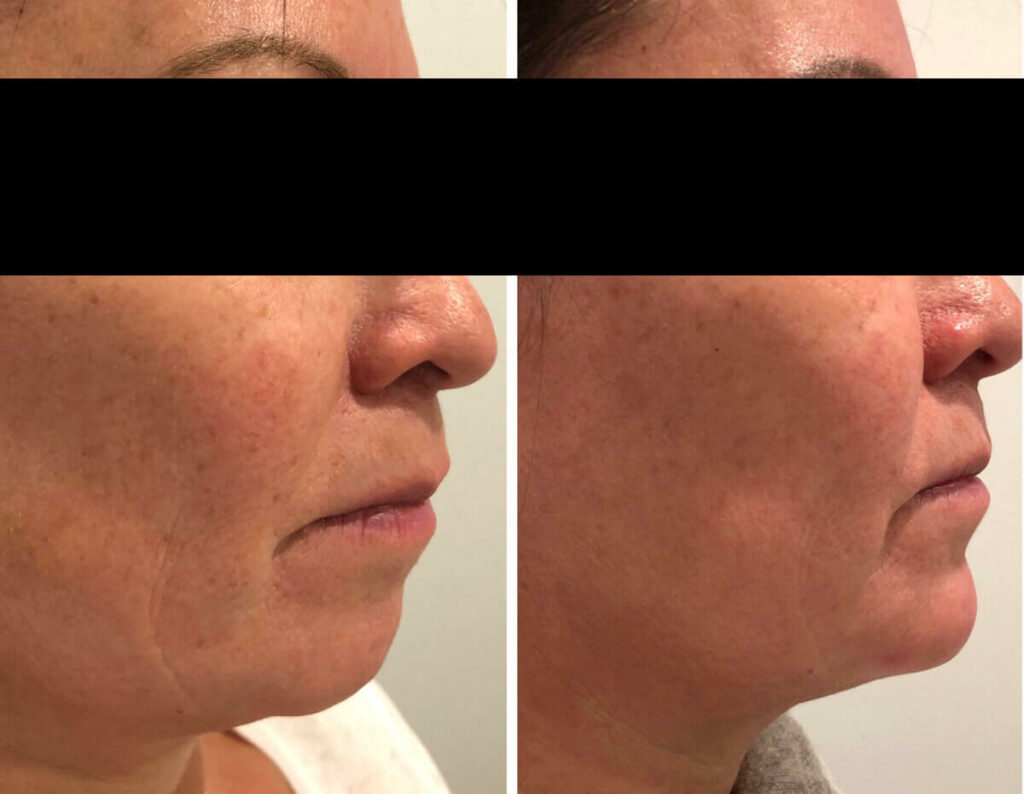 Chin filler before and after