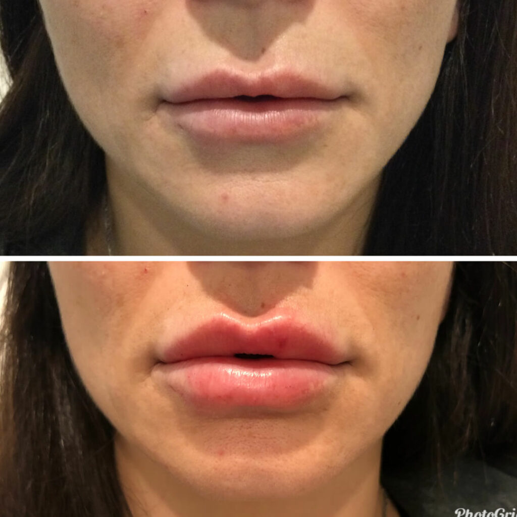 dermal lips filler before and after