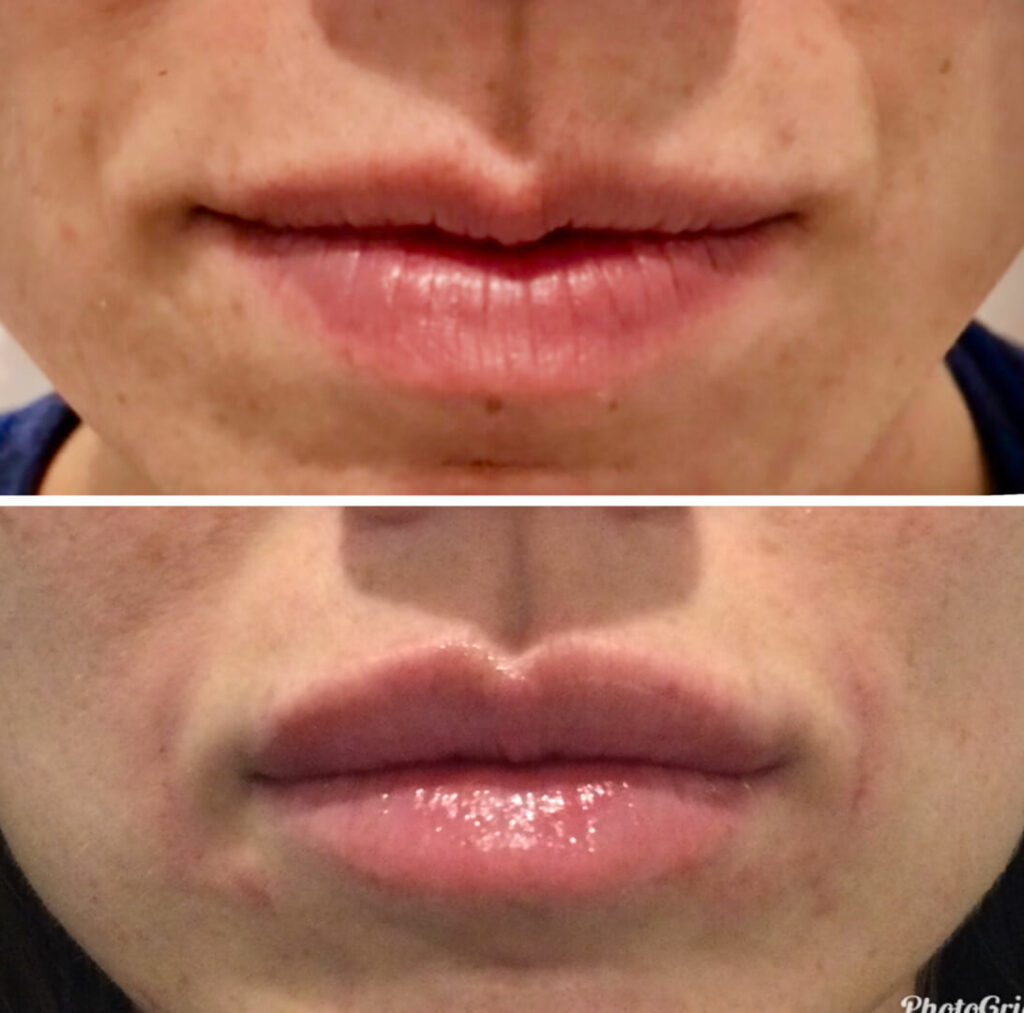 dermal lips filler before and after