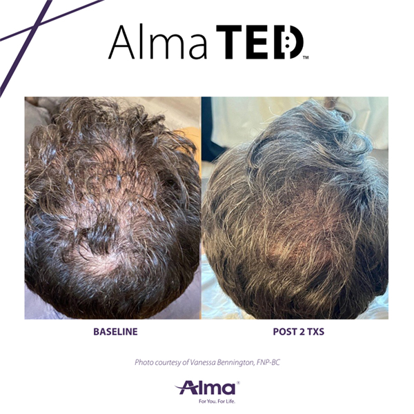Alma TED hair loss restoration before and after
