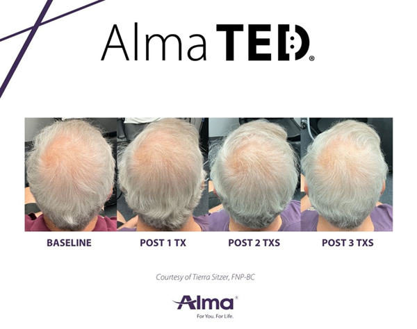 Alma TED Hair restoration treatment progression